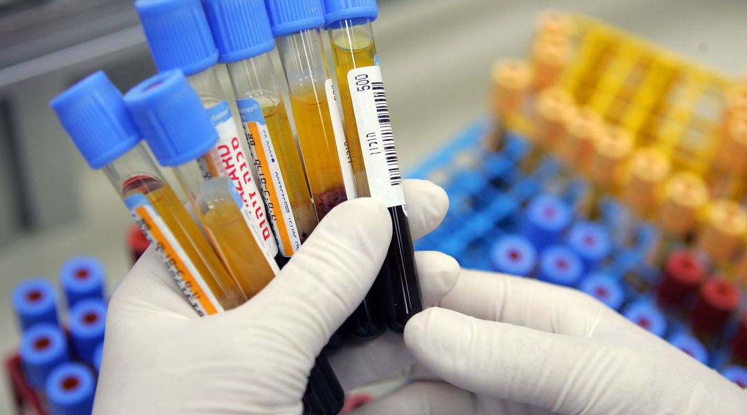 A $10,169 blood test is everything wrong with American health care